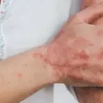 Увага, кір! Лікарі розповіли, як розпізнати симптоми небезпечної хвороби