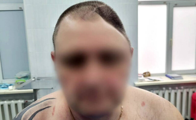 У Вінниці лікарі відновили череп військовому після мінно-вибухової травми