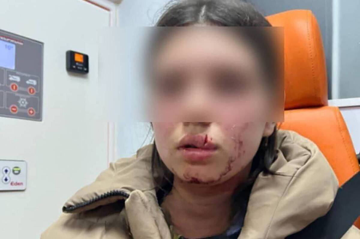 На Вінниччині підліток понівечив обличчя 13-річної дівчинки: що відомо про інцидент