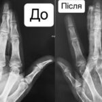 Впав з самоката і отримав перелом: вінницькі медики врятували палець хлопчика (ФОТО)
