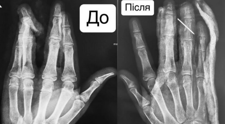 Впав з самоката і отримав перелом: вінницькі медики врятували палець хлопчика (ФОТО)