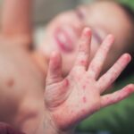 На Вінниччині спалах кору: за пів року 200 випадків, більшість хворих діти