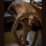 Наслідки полону: лікар-реабілітолог показав стан звільненого захисника (ФОТО)