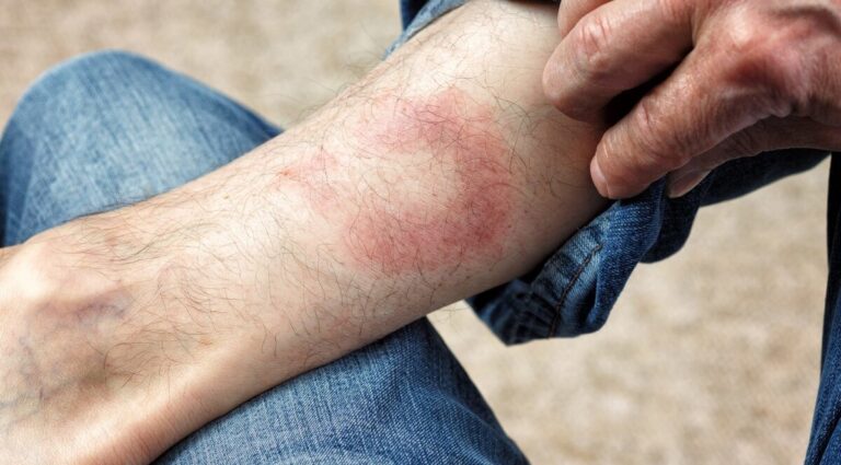 Кліщі, кишкові інфекції та лептоспіроз: чим найчастіше хворіли вінничани у червні